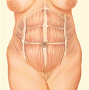 Tummy Tuck Surgery Honolulu Hawaii, Abdominoplasty